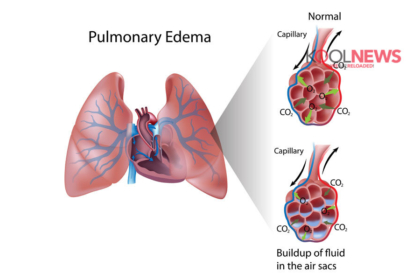 Τι είναι το πνευμονικό οίδημα