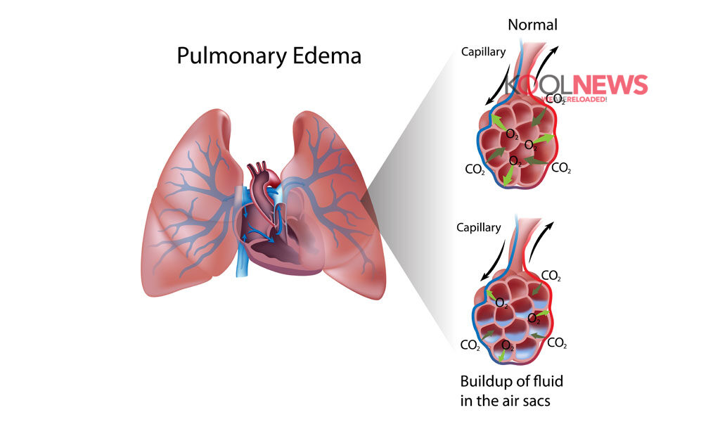 Τι είναι το πνευμονικό οίδημα